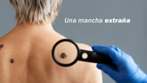 cancer de piel sintomas