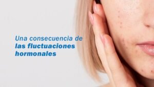 Acné hormonal