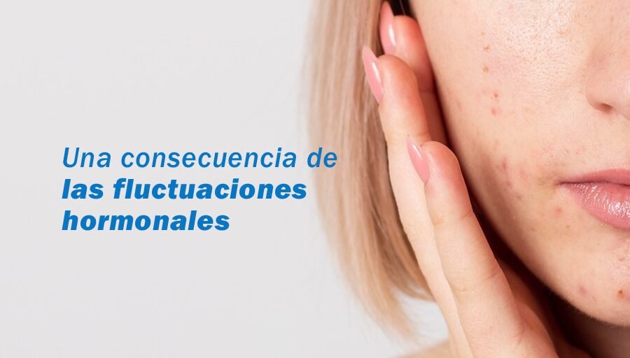 Acné hormonal en mujeres: causas ocultas y cómo tratarlo definitivamente