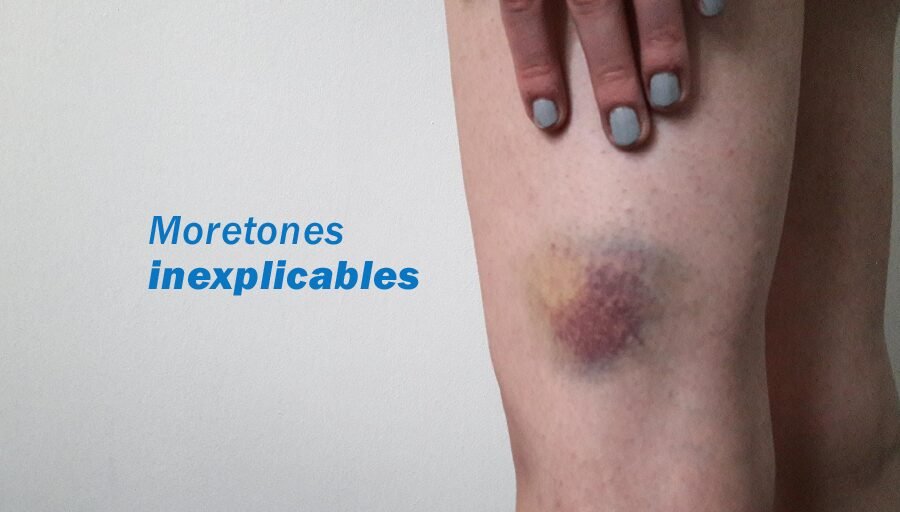 púrpura trombocitopénica idiopática